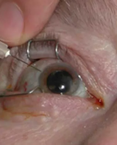 A closeup photo of an intravitreal injection