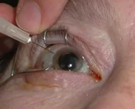 A closeup photo of an intravitreal injection